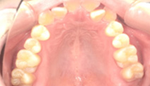 【症例2】下顎前突傾向のある前歯部叢生