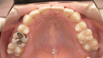 【症例2】下顎前突傾向のある前歯部叢生