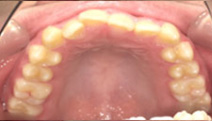 【症例3】骨格性下顎前突および左右非対称を伴う顎変形症