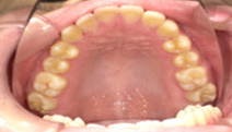 【症例3】骨格性下顎前突および左右非対称を伴う顎変形症
